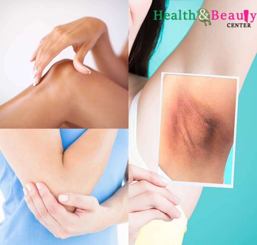 How to remove dry and dark skin on your neck, elbows, knees and underarm